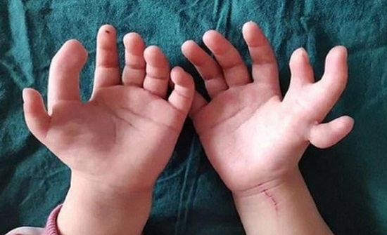لن تصدق.. طفلة بـ (14) إصبعا لن تصدق.. طفلة بـ (14) إصبعا