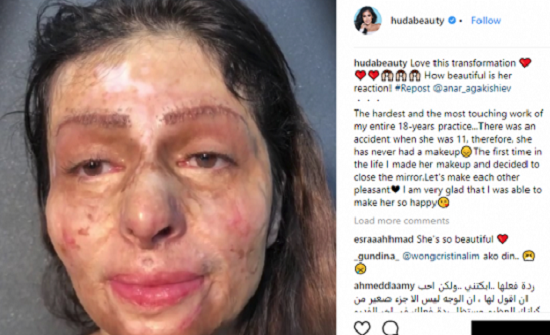 فيديو: بعد ان وضعوا المكياج على وجهها المحروق.. شاهد التحول المذهل! فيديو: بعد ان وضعوا المكياج على وجهها المحروق.. شاهد التحول المذهل!