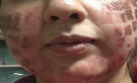 ذهبت لمركز تجميل استعداداً لزفافها.. فخرجت مشوهة وبعاهة مستديمة! ذهبت لمركز تجميل استعداداً لزفافها.. فخرجت مشوهة وبعاهة مستديمة!