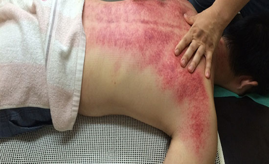 حروق الليزر: أسباب وحلول وطرق وقاية حروق الليزر: أسباب وحلول وطرق وقاية