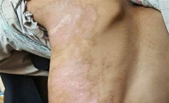 شاهد بالصور : في بلد عربي : قصة تعذيب أب لأطفاله كسر يد طفلته وسكب شاي مغلي على ابنه شاهد بالصور : في بلد عربي : قصة تعذيب أب لأطفاله كسر يد طفلته وسكب شاي مغلي على ابنه