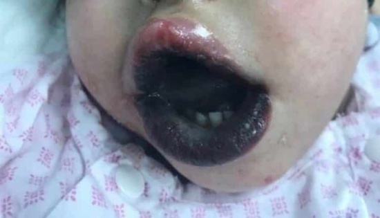 أسرة تقاضي شركة منتجة للمنظفات المنزلية لتسببها في دخول ابنتهم إلى العناية المركزة أسرة تقاضي شركة منتجة للمنظفات المنزلية لتسببها في دخول ابنتهم إلى العناية المركزة