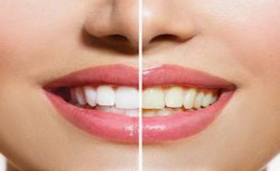 كيف تتخلصون من اصفرار الأسنان بطرق طبيعية؟ كيف تتخلصون من اصفرار الأسنان بطرق طبيعية؟