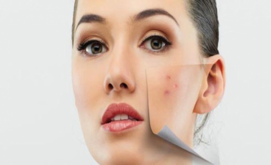علاج حب الشباب وأنواعه وكيفية التخلص من آثاره على الوجه علاج حب الشباب وأنواعه وكيفية التخلص من آثاره على الوجه
