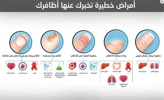 أمراض خطيرة تخبرك عنها أظافر اليد أمراض خطيرة تخبرك عنها أظافر اليد