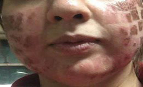 مصرية ذهبت لمركز تجميل استعدادا لزفافها.. فخرجت مشوهة مصرية ذهبت لمركز تجميل استعدادا لزفافها.. فخرجت مشوهة