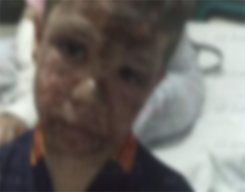 مصابو جريمة إلقاء ماء النار على "معازيم فرح" يروون تفاصيل صادمة في مصر مصابو جريمة إلقاء ماء النار على "معازيم فرح" يروون تفاصيل صادمة في مصر