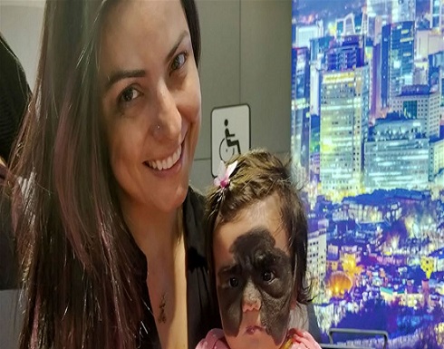 وحمة ضخمة تغطي وجه طفلة أميركية.. وأطباء يعملون على إزالتها! وحمة ضخمة تغطي وجه طفلة أميركية.. وأطباء يعملون على إزالتها!