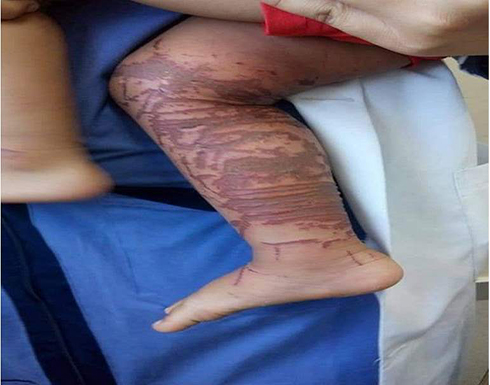 هذا ما فعله قنديل البحر بطفل في غزة هذا ما فعله قنديل البحر بطفل في غزة