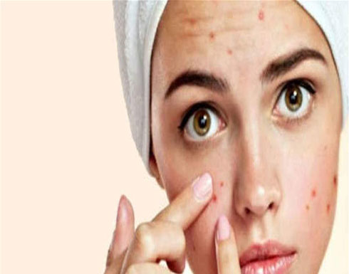 لماذا يظهر حب الشباب بعد الثلاثين من العمر؟ لماذا يظهر حب الشباب بعد الثلاثين من العمر؟