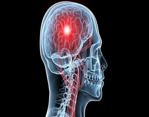 ما هي الأعراض الأولية للجلطة الدماغية؟ ما هي الأعراض الأولية للجلطة الدماغية؟