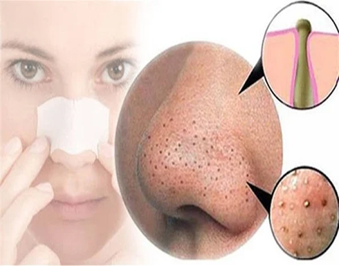 حيلة طبيعية سهلة لعلاج الرؤوس السوداء حيلة طبيعية سهلة لعلاج الرؤوس السوداء
