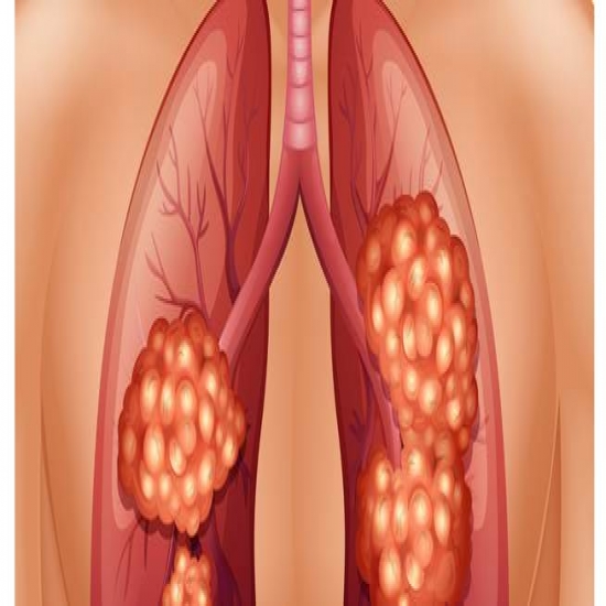 تعرف على المرحلة الثالثة من سرطان الرئة