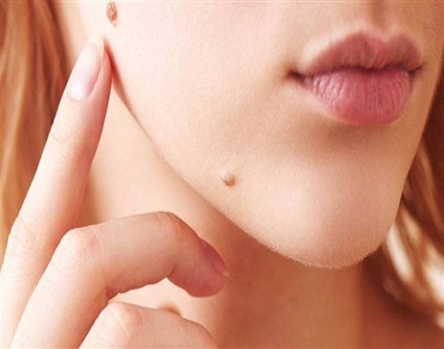 الشامة : قد تشير إلى سرطان الجلد الأسود .... تفاصيل