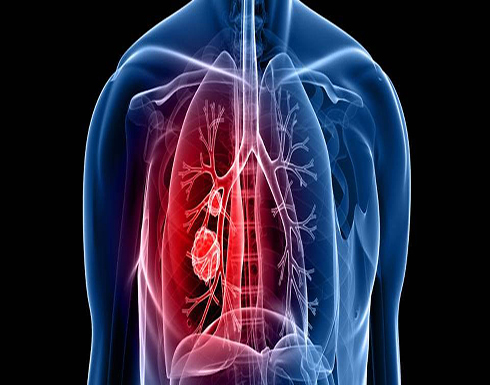 اختبار دم للمدخنين يتنبئ بـ«سرطان الرئة» قبل 4 سنوات من ظهور الأعراض