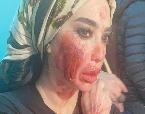 شاهد : بروكار يشوّه وجه الممثلة السورية رنا أبيض شاهد : بروكار يشوّه وجه الممثلة السورية رنا أبيض
