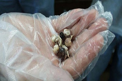 وصفة طبيعية للتخلص من حصاوى الكلى في عدة ساعات وصفة طبيعية للتخلص من حصاوى الكلى في عدة ساعات