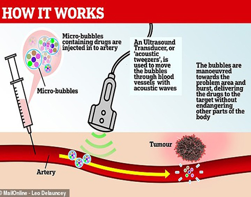 علاج جديد للسرطان عن طريق فقاعات توجه للورم عبر موجات الصوت