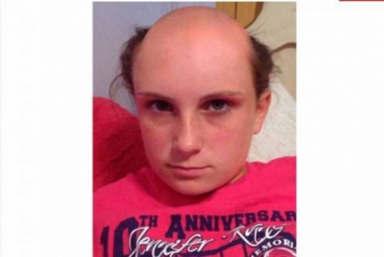 صور: فتاة صلعاء تثير ضجة على الانترنت!