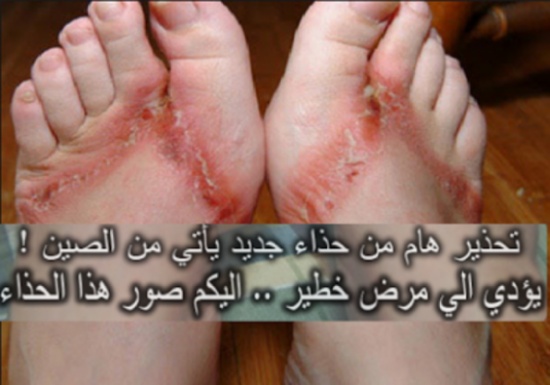 صورة| تحذير من حذاء خطير يأتي من الصين ويسبب مرض خطير!