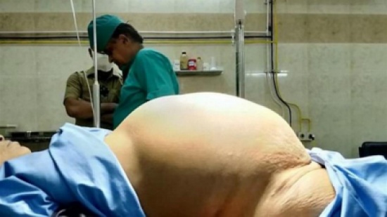 استأصلوا من مبيضها ورماً يزن 11.8 كيلوغراما! استأصلوا من مبيضها ورماً يزن 11.8 كيلوغراما!