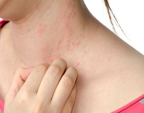 دواء للإكزيما يستخدم لعلاج فيروس كورونا دواء للإكزيما يستخدم لعلاج فيروس كورونا