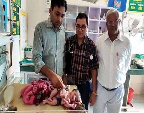 صدمة طبية.. ولادة طفلة بأربع أرجل و3 أياد صدمة طبية.. ولادة طفلة بأربع أرجل و3 أياد