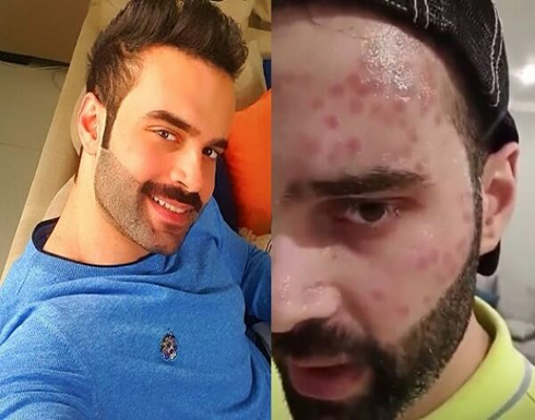 سعود بوشهري يكشف عن تشوه في وجهه منعه من الظهور الإعلامي: فنانة حسدتني -فيديو سعود بوشهري يكشف عن تشوه في وجهه منعه من الظهور الإعلامي: فنانة حسدتني -فيديو