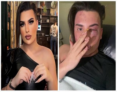تعرض شاب متحول جنسياً للضرب العنيف.. وأثار الإعتداء واضحة عليه في دولة عربية تعرض شاب متحول جنسياً للضرب العنيف.. وأثار الإعتداء واضحة عليه في دولة عربية