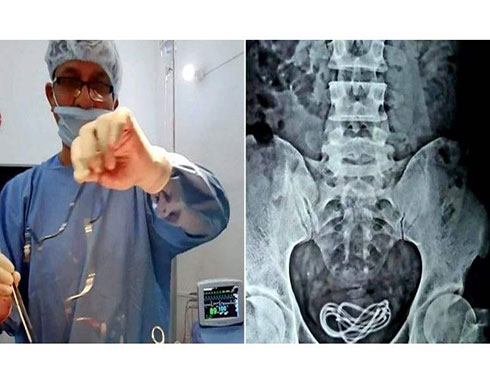 إزالة شاحن هاتف طوله 60 سم من مثانة شاب .. تفاصيل إزالة شاحن هاتف طوله 60 سم من مثانة شاب .. تفاصيل