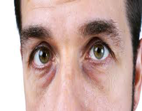 5 أسباب غير النوم تسبب انتفاخ العين.. ما هي؟ 5 أسباب غير النوم تسبب انتفاخ العين.. ما هي؟