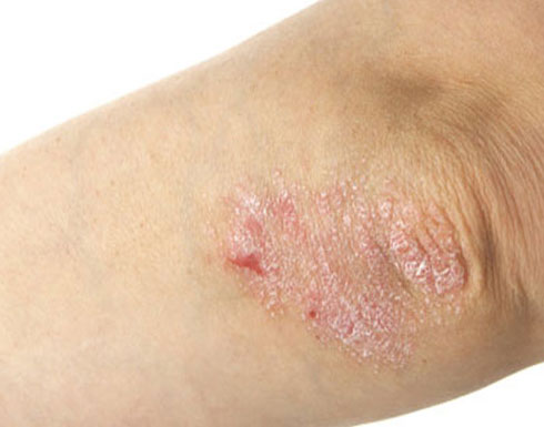 كيف تتعالج من الصدفية؟