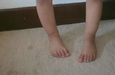 الجراحة الحل الأمثل لمريض تقوس الساقين