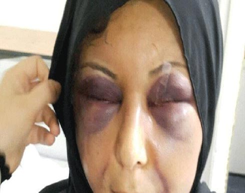 خليجي يشوه وجهه زوجته للزواج بأخرى تعيله خليجي يشوه وجهه زوجته للزواج بأخرى تعيله
