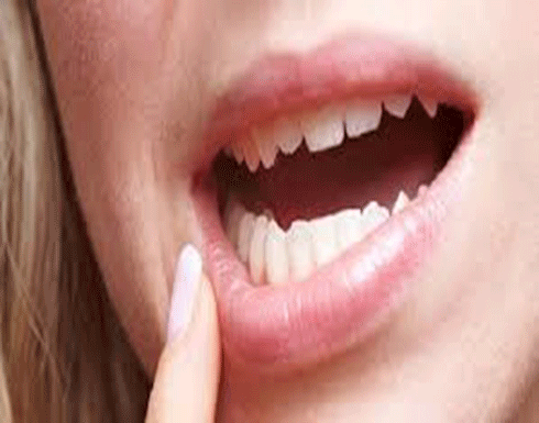 طرق سريعة للقضاء على تقرحات الفم طرق سريعة للقضاء على تقرحات الفم