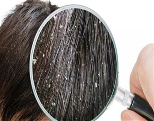 اقضِ على قشرة الرأس للأبد اقضِ على قشرة الرأس للأبد