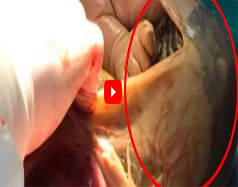 ظلت حاملا ل 41 اسبوع دون الذهاب الى الطبيب وعند الولادة حدثت المفاجأة..!! ظلت حاملا ل 41 اسبوع دون الذهاب الى الطبيب وعند الولادة حدثت المفاجأة..!!