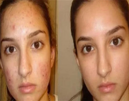 وصفة لعلاج آثار حب الشباب نهائيا وصفة لعلاج آثار حب الشباب نهائيا