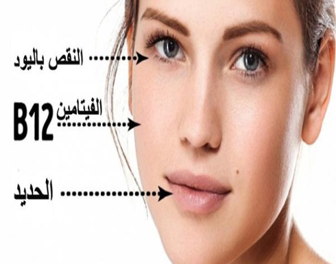5 علامات عن النقص بالفيتامينات مكتوبة على وجهك 5 علامات عن النقص بالفيتامينات مكتوبة على وجهك