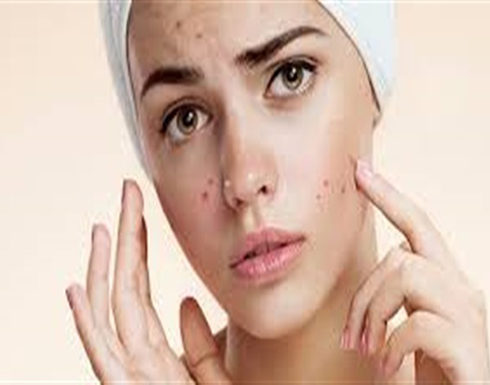 توقف عن تناولها فورا .. أطعمة تصيب بحب الشباب توقف عن تناولها فورا .. أطعمة تصيب بحب الشباب