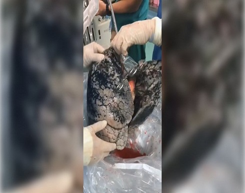 مشهد مروع يكشف ماذا حدث لرئتي رجل دخن السجائر لـ30 عاما (فيديو) مشهد مروع يكشف ماذا حدث لرئتي رجل دخن السجائر لـ30 عاما (فيديو)
