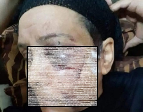 مصر : 14 غرزة في عينها وكسر في العظام ... الام المعتدى عليها من ابنها تروي التفاصيل مصر : 14 غرزة في عينها وكسر في العظام ... الام المعتدى عليها من ابنها تروي التفاصيل