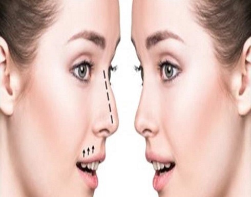 هذا ما يجب أن تعرفيه عن جراحة الأنف المائل هذا ما يجب أن تعرفيه عن جراحة الأنف المائل