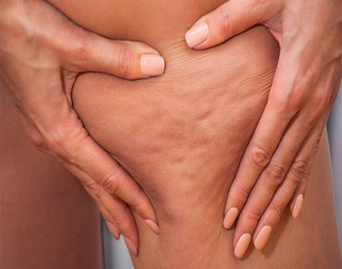 أسباب السيلوليت عند النساء .. 7 طرق مختلفة للعلاج أسباب السيلوليت عند النساء .. 7 طرق مختلفة للعلاج