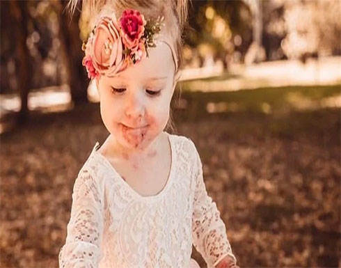 صور : جروح لا تلتئم.. طفلة استرالية تولد بدون جلد بسبب مرض نادر صور : جروح لا تلتئم.. طفلة استرالية تولد بدون جلد بسبب مرض نادر