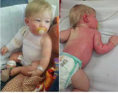 بالصور| طفل أصيب بحروق من الدرجة الثانية بعد أن رشته أمه بخرطوم المياه..كيف حصل ذلك؟!