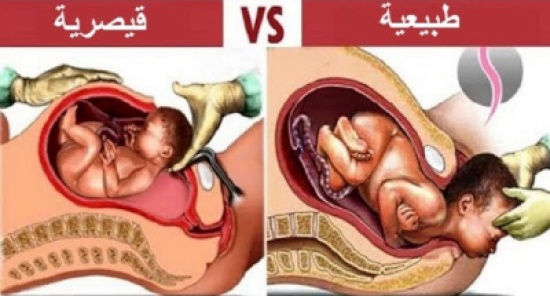 10 اشياء صادمة لاتعرفها عن الولادة القيصرية وللاسف الكل لايعرفها