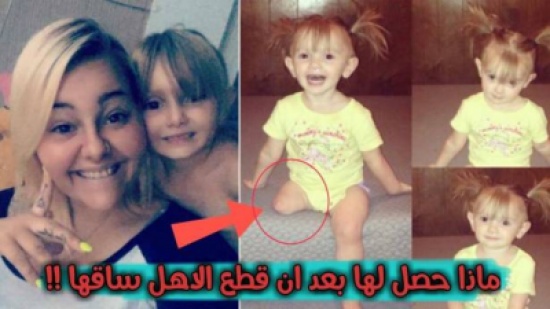 بالفيديو: أصّر الأهل أن يقطعوا ساق ابنتهما رغم اعتراض الأطباء.. انظروا ما حدث لها ! بالفيديو: أصّر الأهل أن يقطعوا ساق ابنتهما رغم اعتراض الأطباء.. انظروا ما حدث لها !