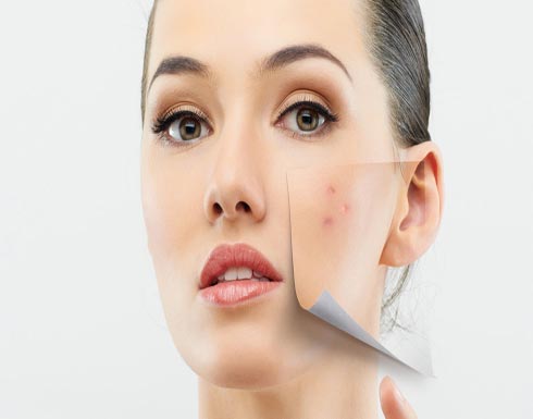 طرق لمحاربة البثور الهرمونية طرق لمحاربة البثور الهرمونية