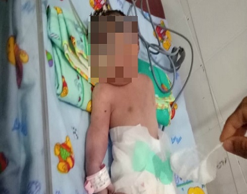 بعين واحدة دون أنف.. ولادة نادرة لطفلة في اندونيسيا بعين واحدة دون أنف.. ولادة نادرة لطفلة في اندونيسيا